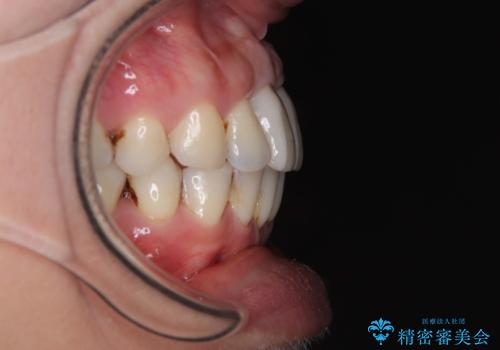 隙間をセラミックで閉じたら不格好で歯肉から出血 矯正治療と歯周外科で綺麗な前歯にの治療後