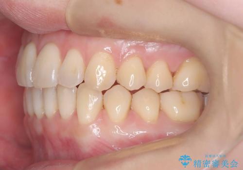 【インビザライン、10ヵ月で矯正終了!】下の前歯が斜めになっているのを治したい!の治療後