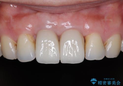 隙間をセラミックで閉じたら不格好で歯肉から出血 矯正治療と歯周外科で綺麗な前歯にの症例 治療後