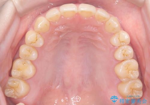 【インビザライン、10ヵ月で矯正終了!】下の前歯が斜めになっているのを治したい!の治療後