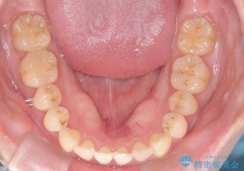 【インビザライン、10ヵ月で矯正終了!】下の前歯が斜めになっているのを治したい!の治療後