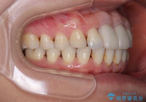 隙間をセラミックで閉じたら不格好で歯肉から出血 矯正治療と歯周外科で綺麗な前歯にの治療後