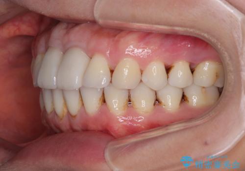 隙間をセラミックで閉じたら不格好で歯肉から出血 矯正治療と歯周外科で綺麗な前歯にの治療後