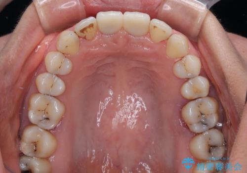 隙間をセラミックで閉じたら不格好で歯肉から出血 矯正治療と歯周外科で綺麗な前歯にの治療後