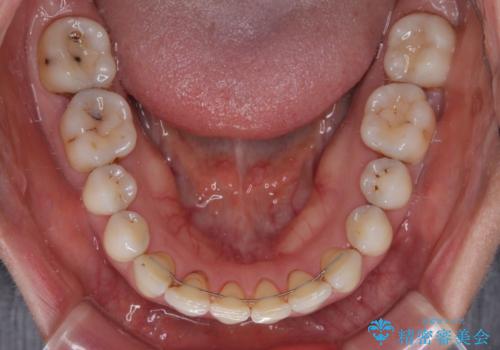 隙間をセラミックで閉じたら不格好で歯肉から出血 矯正治療と歯周外科で綺麗な前歯にの治療後