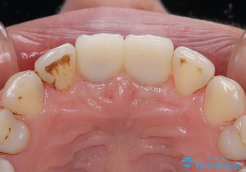 隙間をセラミックで閉じたら不格好で歯肉から出血　矯正治療と歯周外科で綺麗な前歯にの治療後