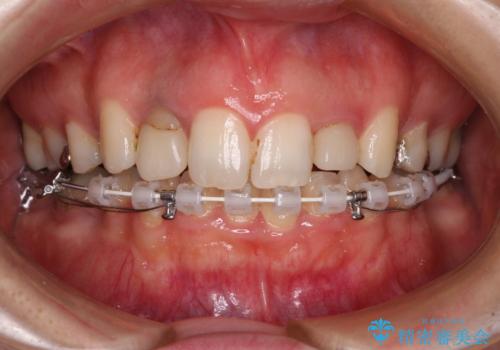 飛び出した上顎前歯とむし歯の多い歯列 目立たないハーフリンガル矯正とむし歯治療の治療中