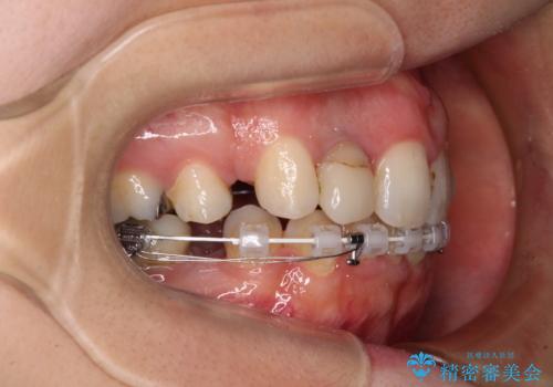 飛び出した上顎前歯とむし歯の多い歯列 目立たないハーフリンガル矯正とむし歯治療の治療中