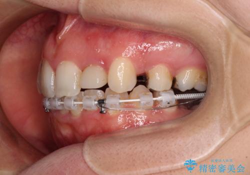 飛び出した上顎前歯とむし歯の多い歯列 目立たないハーフリンガル矯正とむし歯治療の治療中