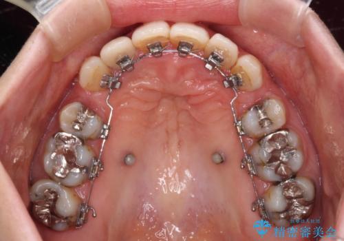 飛び出した上顎前歯とむし歯の多い歯列 目立たないハーフリンガル矯正とむし歯治療の治療中