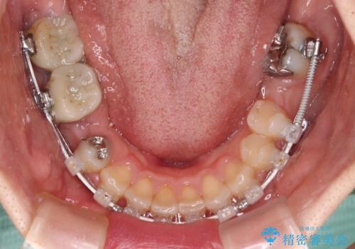 飛び出した上顎前歯とむし歯の多い歯列　目立たないハーフリンガル矯正とむし歯治療の治療中
