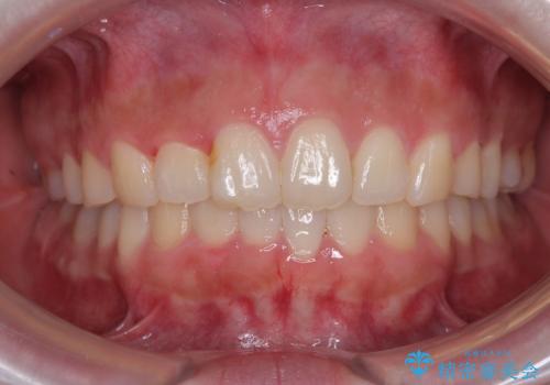 前歯のデコボコをインビザラインできれいに整えるの症例 治療後