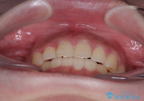 前歯のデコボコをインビザラインできれいに整えるの治療後