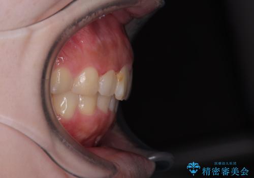 前歯のデコボコをインビザラインできれいに整えるの治療後