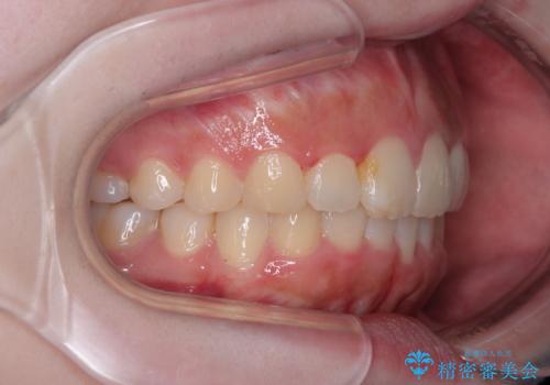 前歯のデコボコをインビザラインできれいに整えるの治療後