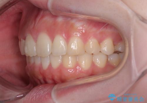 前歯のデコボコをインビザラインできれいに整えるの治療後