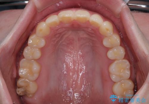 前歯のデコボコをインビザラインできれいに整えるの治療後