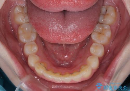 前歯のデコボコをインビザラインできれいに整えるの治療後
