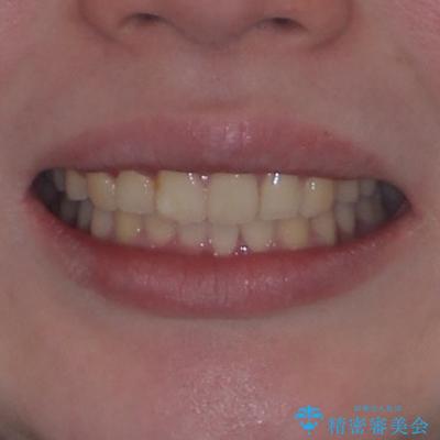 前歯のデコボコをインビザラインできれいに整えるの治療後(顔貌)