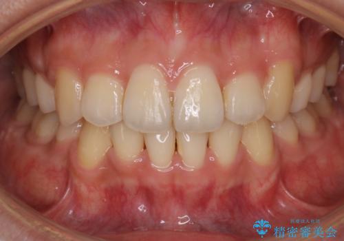 【クリア装置】八重歯の矯正治療の症例 治療後