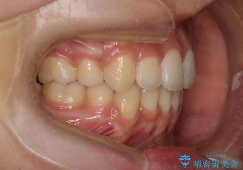 【クリア装置】八重歯の矯正治療の治療後