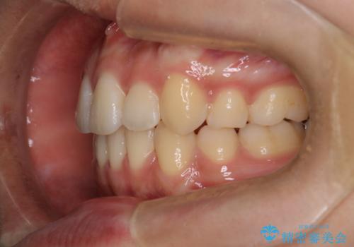 【クリア装置】八重歯の矯正治療の治療後