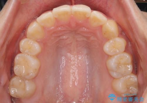【クリア装置】八重歯の矯正治療の治療後