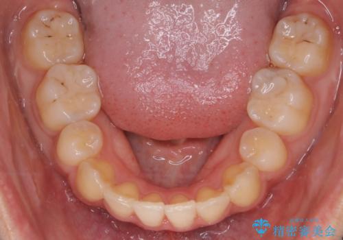 【クリア装置】八重歯の矯正治療の治療後