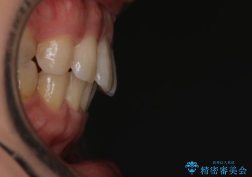 【審美装置】前歯をきれいにしたいの治療後