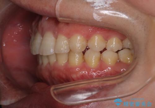 【審美装置】前歯をきれいにしたいの治療後