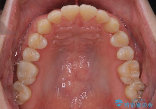 【審美装置】前歯をきれいにしたいの治療後
