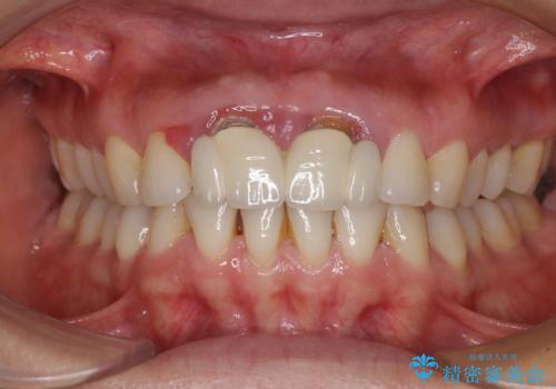 隙間をセラミックで閉じたら不格好で歯肉から出血 矯正治療と歯周外科で綺麗な前歯にの治療前