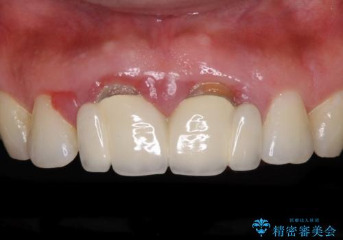 隙間をセラミックで閉じたら不格好で歯肉から出血 矯正治療と歯周外科で綺麗な前歯にの症例 治療前