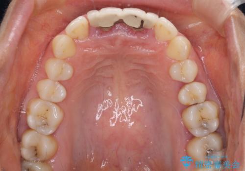 隙間をセラミックで閉じたら不格好で歯肉から出血 矯正治療と歯周外科で綺麗な前歯にの治療前