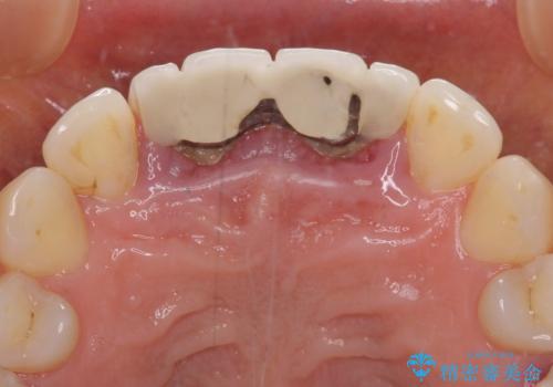隙間をセラミックで閉じたら不格好で歯肉から出血 矯正治療と歯周外科で綺麗な前歯にの治療前