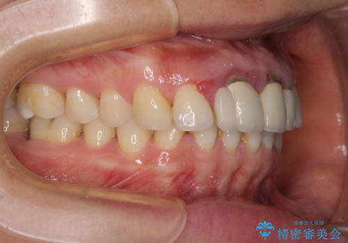 隙間をセラミックで閉じたら不格好で歯肉から出血 矯正治療と歯周外科で綺麗な前歯にの治療前