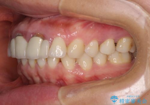 隙間をセラミックで閉じたら不格好で歯肉から出血　矯正治療と歯周外科で綺麗な前歯にの治療前
