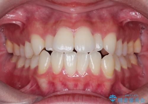 【ワイヤー矯正】口元を歯列矯正で下げたいの症例 治療前