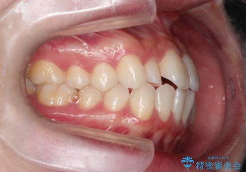 【ワイヤー矯正】口元を歯列矯正で下げたいの治療前