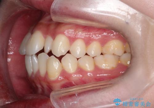 【ワイヤー矯正】口元を歯列矯正で下げたいの治療前