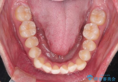 【ワイヤー矯正】口元を歯列矯正で下げたいの治療前