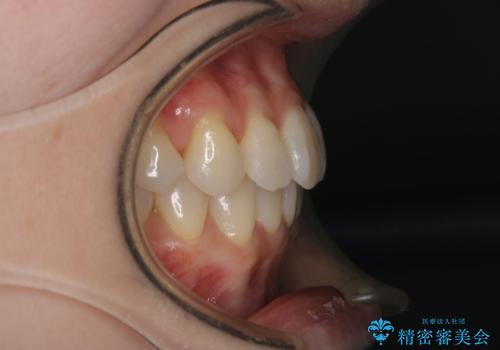 【インビザライン】かみ合わせを整えたいの治療後