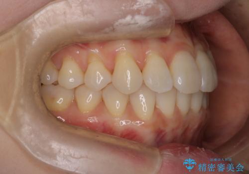 【インビザライン】かみ合わせを整えたいの治療後