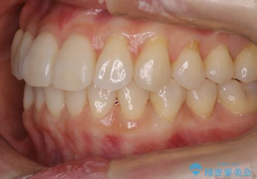 【インビザライン】かみ合わせを整えたいの治療後