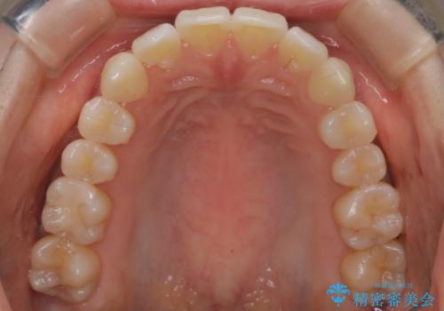 【インビザライン】かみ合わせを整えたいの治療後