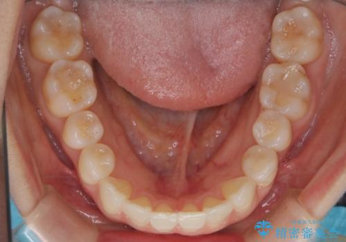 【インビザライン】かみ合わせを整えたいの治療後