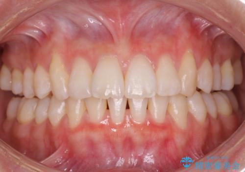 歯を抜かないで出っ歯を治したいの治療中