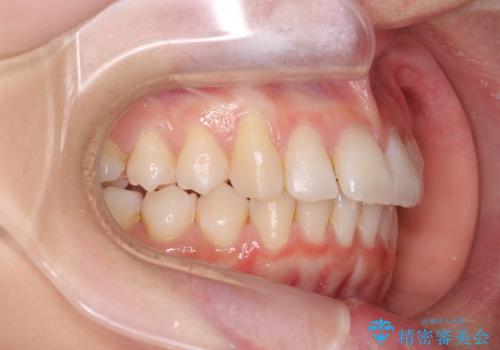 歯を抜かないで出っ歯を治したいの治療中