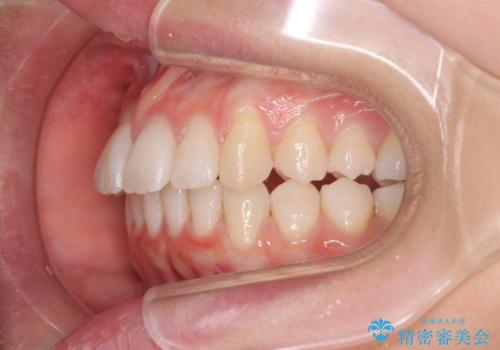 歯を抜かないで出っ歯を治したいの治療中