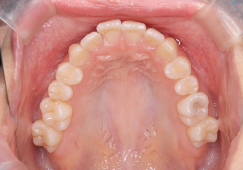 歯を抜かないで出っ歯を治したいの治療中